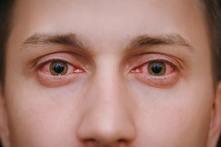 Göz alerjisi neden olur, belirtileri nelerdir? Göz alerjisi nasıl geçer?