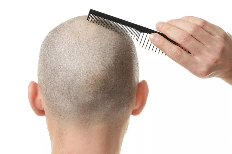 Saç dökülmesi erkeklerin psikolojisini bozuyor! Kellik noktasına varan saç dökülmeleri öz güveni zedeleyip depresyona yol açıyor!