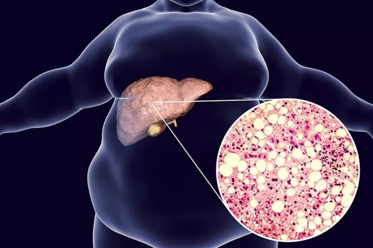 Karaciğerin yağlandığı nasıl anlaşılır? Cilt rengi değişir mi?