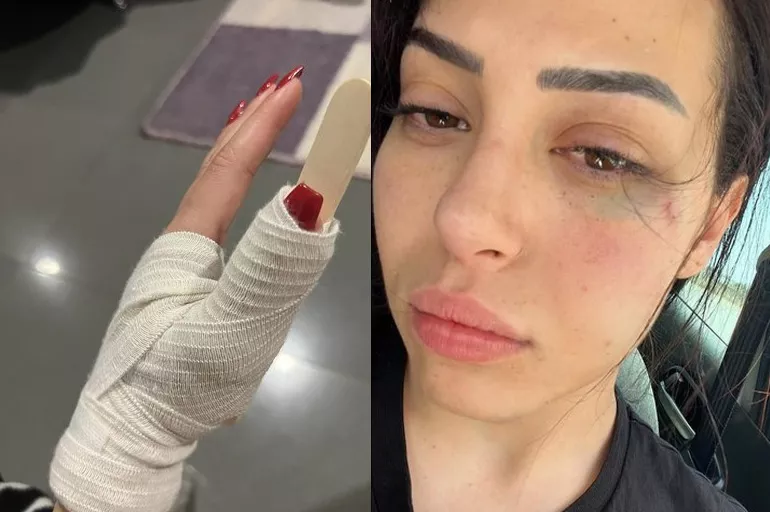 GKRY'de Türk kızına ırkçı saldırı: Dişlerini ve parmağını kırdılar!