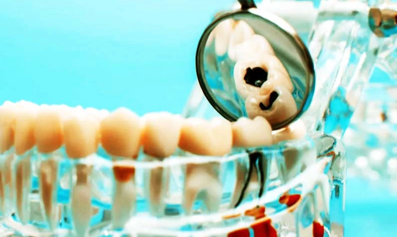 Diş çürükleri o organda kanser ihtimalini artırıyor! İşte çarpıcı araştırmanın bulguları