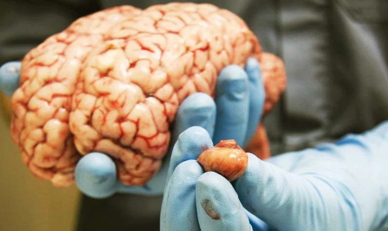 Yeni çalışmalara göre o cihazın kullanımı beyin tümörü riskini artırmıyor! İşte tüm ezberleri bozan araştırmanın detayları